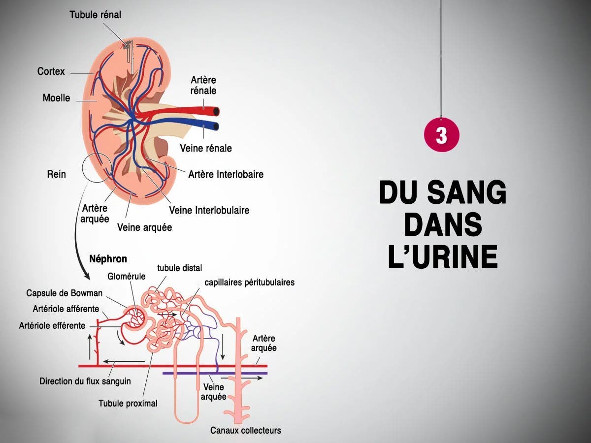 Du sang dans l’urine