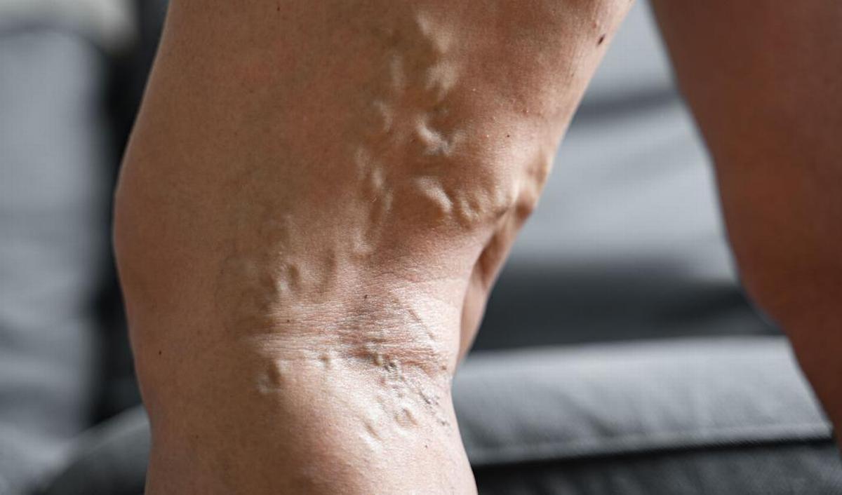 Consultation médicale pour l'examen des veines des jambes