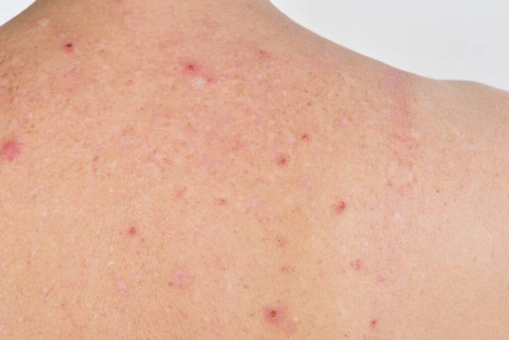 Détail de petits boutons rouges sur la peau liés à la chaleur