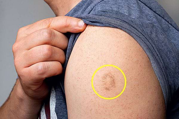 Comparaison visuelle entre différentes anciennes marques de vaccination sur la peau.