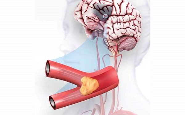 crise cardiaque