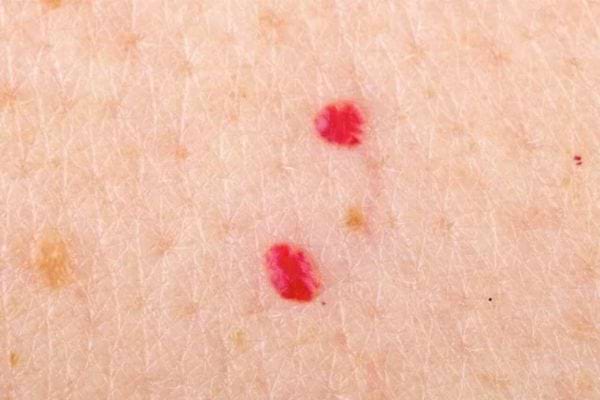 Gros plan sur des angiomes cerise, petites taches vasculaires bénignes
