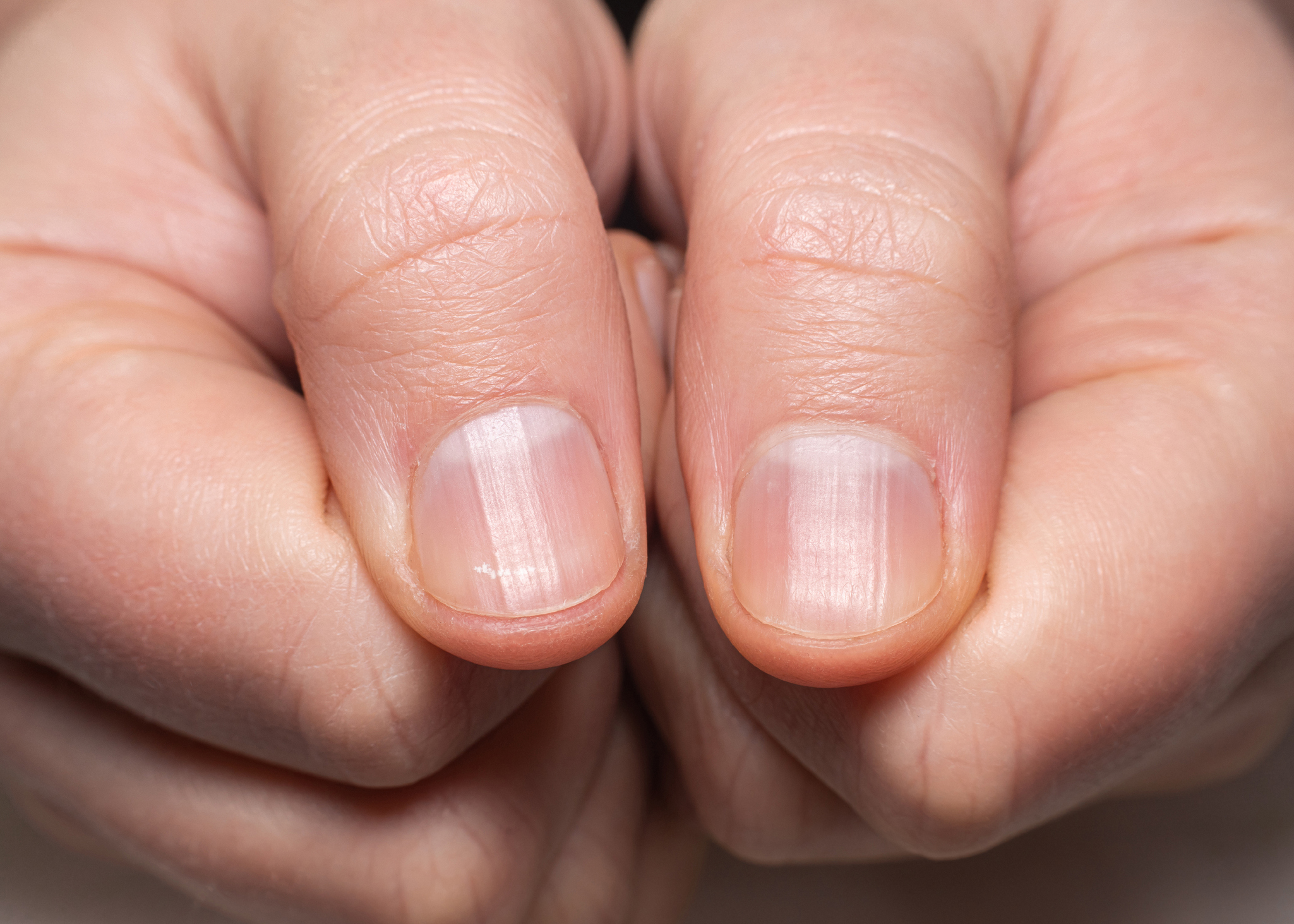 Détail d'un ongle présentant des stries verticales