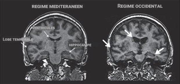 radio d'un cerveau